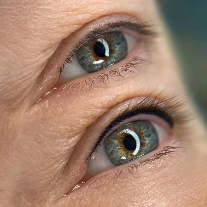 Verdichteter Wimpernkranz an beiden Augen
